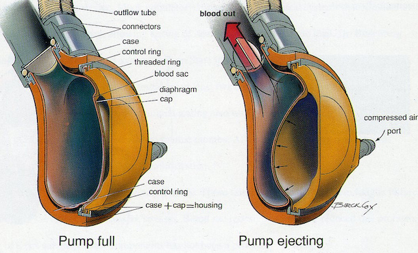 Cross-section illustration of a heart pump in pump full and pump ejecting stages