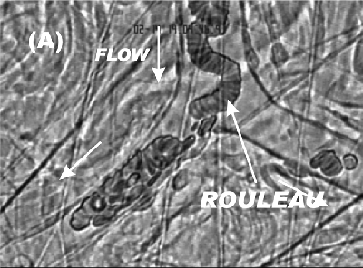 Photo of red cell rouleaux formation